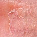 Naturopathic Eczema control with Edmonton's Natural Terrain